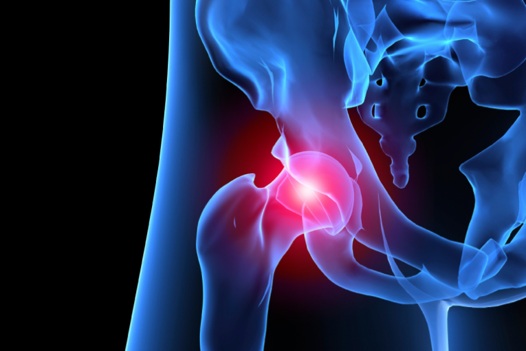 Osteoporose